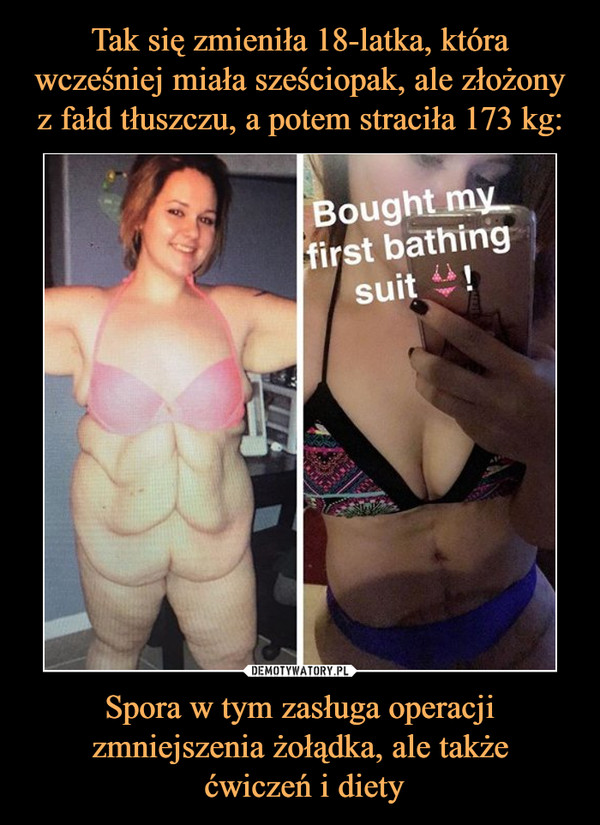 Tak się zmieniła 18-latka, która wcześniej miała sześciopak, ale złożony z fałd tłuszczu, a potem straciła 173 kg: Spora w tym zasługa operacji zmniejszenia żołądka, ale także
 ćwiczeń i diety