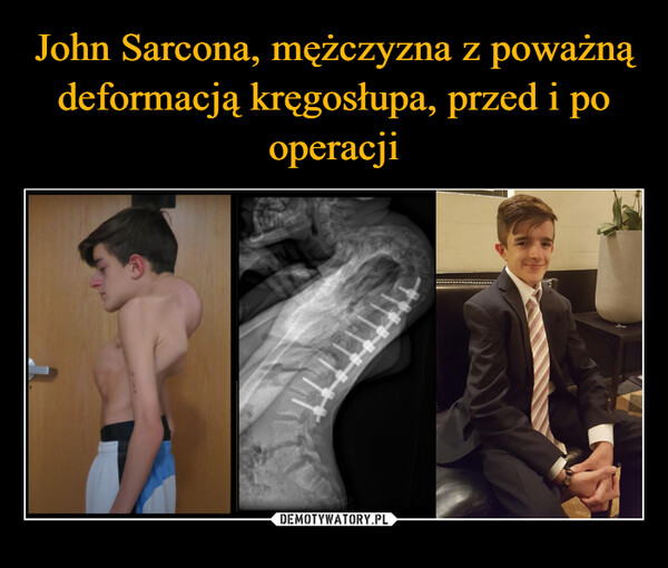 John Sarcona, mężczyzna z poważną deformacją kręgosłupa, przed i po operacji
