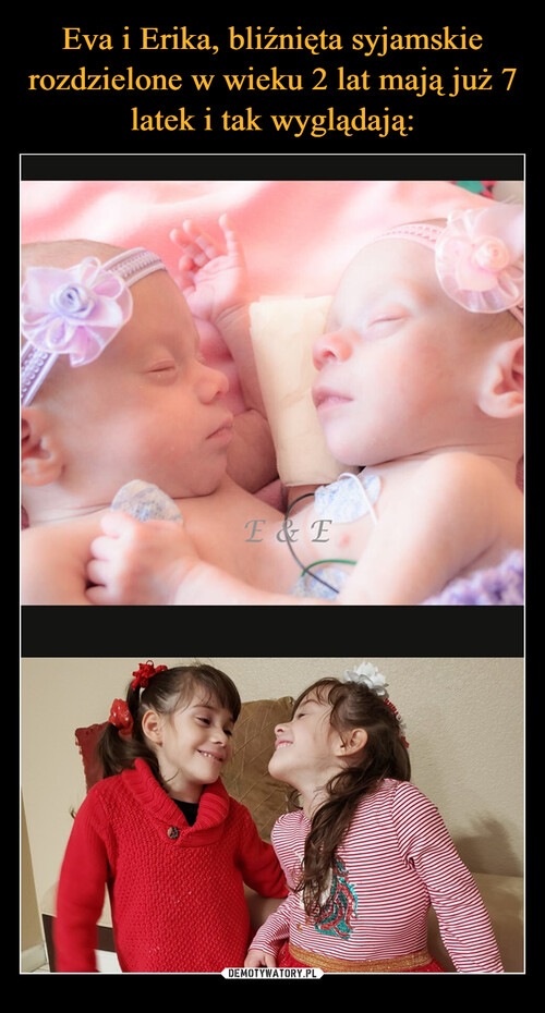Eva i Erika, bliźnięta syjamskie rozdzielone w wieku 2 lat mają już 7 latek i tak wyglądają: