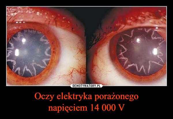 Oczy elektryka porażonego
napięciem 14 000 V
