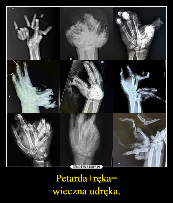 Petarda+ręka=wieczna udręka. –  jdl